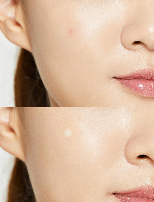 COSRX - Acné Pimple Master Patches 24 Piezas | Parches para acné